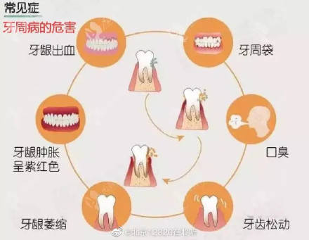 牙周炎有哪些表现？ (图1)