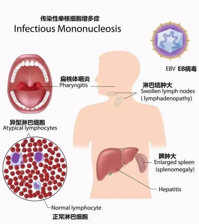 18岁男生高烧3天不退确诊接吻病 医生:严重可致命!(图7)