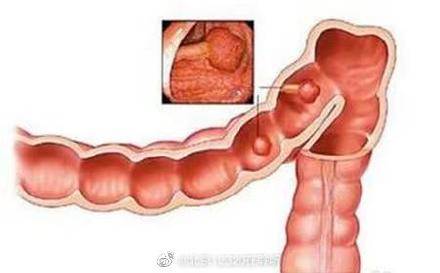 结肠息肉切除术后需要注意什么？ (图1)