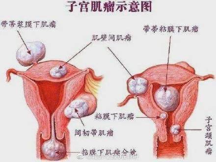 手术能否彻底清除子宫肌瘤？ (图1)