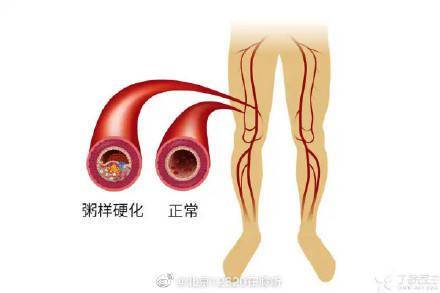 下肢动脉硬化闭塞症有什么症状？ (图1)