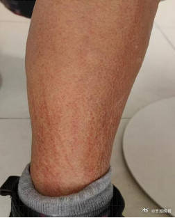女子吃完香菇汤双腿现鞭打痕 (pic1) 女子吃完香菇汤双腿现鞭打痕 (pic1)