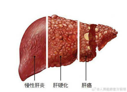 男子身上发痒检查后确诊肝癌 (pic1)