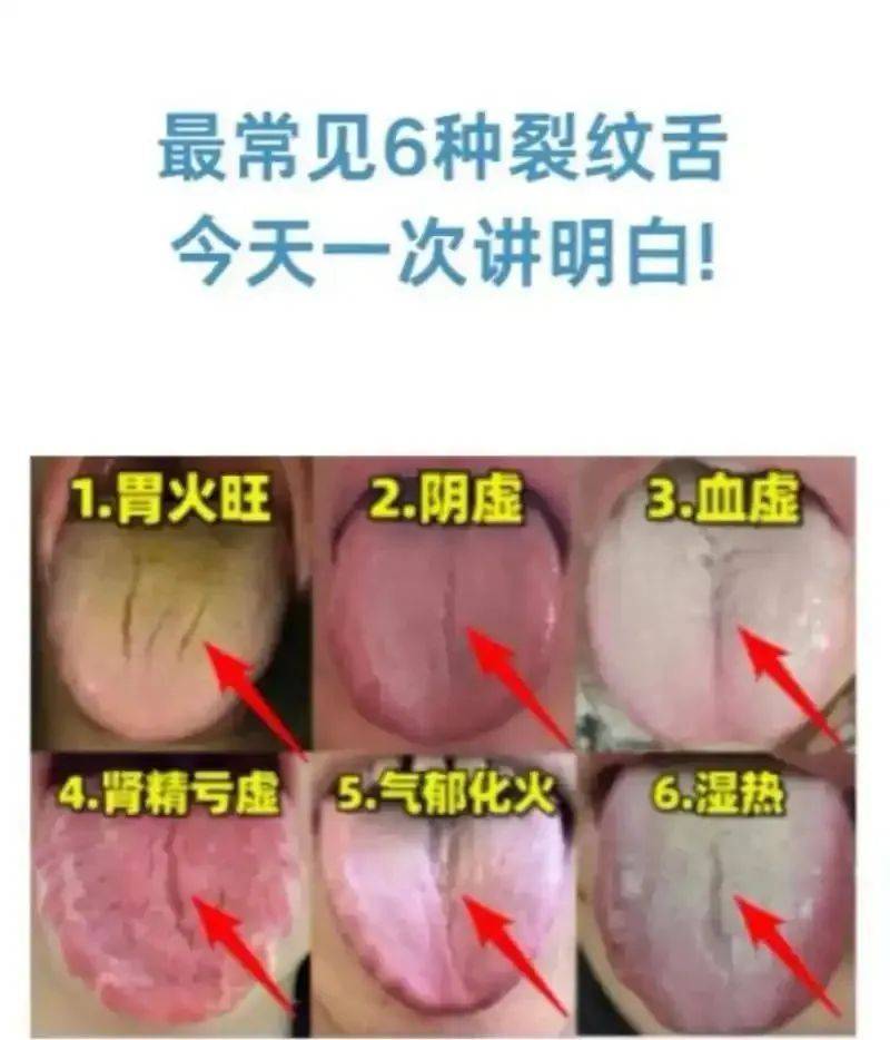 舌头有裂纹?别慌!中医教你读懂身体的“求救信号” (pic1) 舌头有裂纹?别慌!中医教你读懂身体的“求救信号” (pic1)