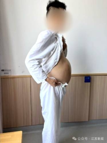 男子4个月没排便，腹中掏出20多斤、2米长“巨蟒”结肠 (pic1)