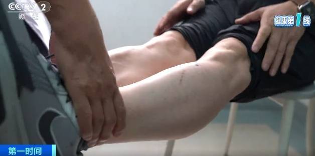 超1亿人患病!以为关节炎只是老年病?这些因素正让它悄悄盯上年轻人 (pic3) 超1亿人患病!以为关节炎只是老年病?这些因素正让它悄悄盯上年轻人 (pic3)