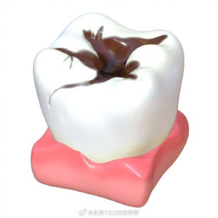 慢性牙髓炎发作时的疼痛有什么特点？ (pic1)