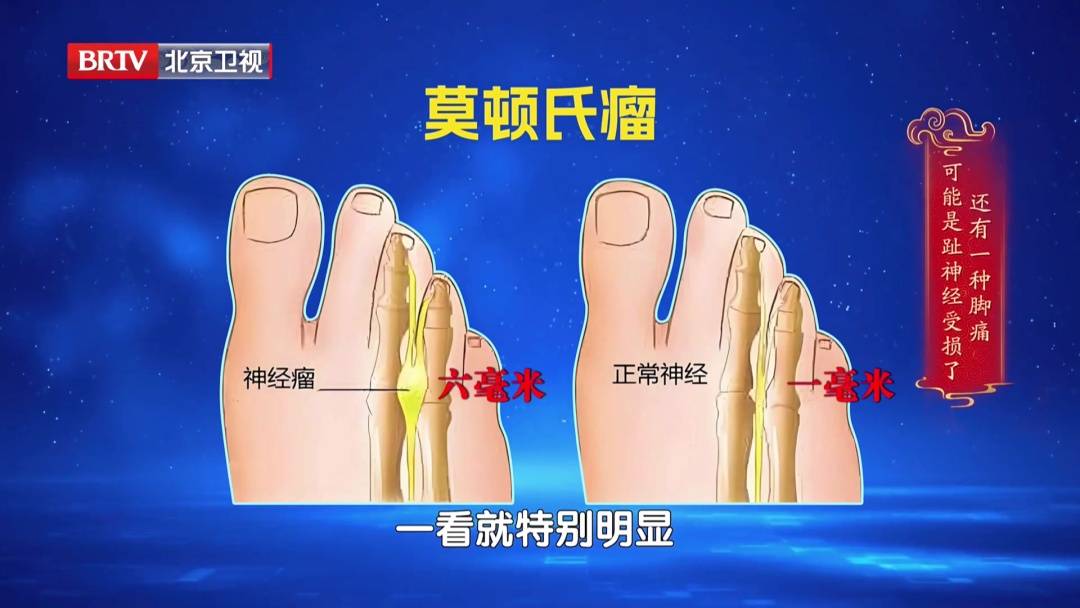 走路多了脚疼不正常？医生：这种疼可能是神经在报警，两个小妙招，轻松护足 (pic15)