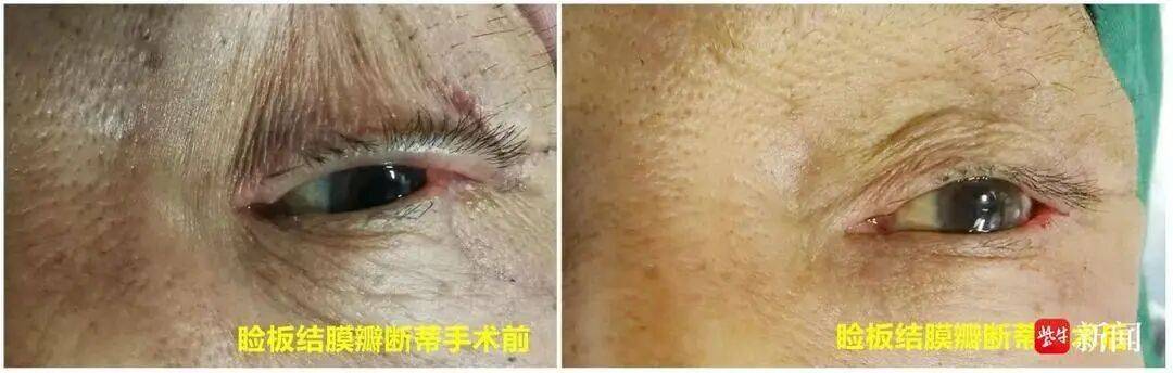 眼皮上黄豆大肉疙瘩越长越大，实则是恶性肿瘤，已侵害眼睑结构和功能 (pic1)